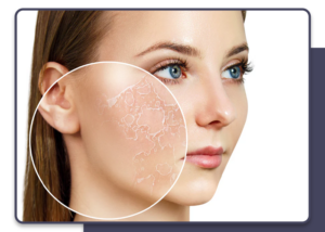 Dry skin or Xerosis