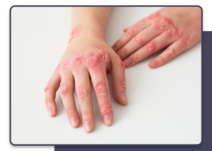 Fungal infections