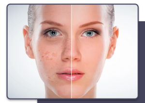 Hyperpigmentation