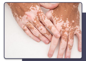 Vitiligo