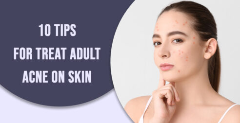 10 Tips for Treat Adult Acne on Skin