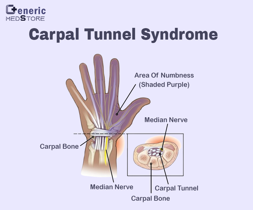 Carpal tunnel syndrome