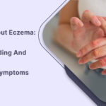 The Truth About Eczema Managing Symptoms