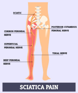 Sciatica Pain