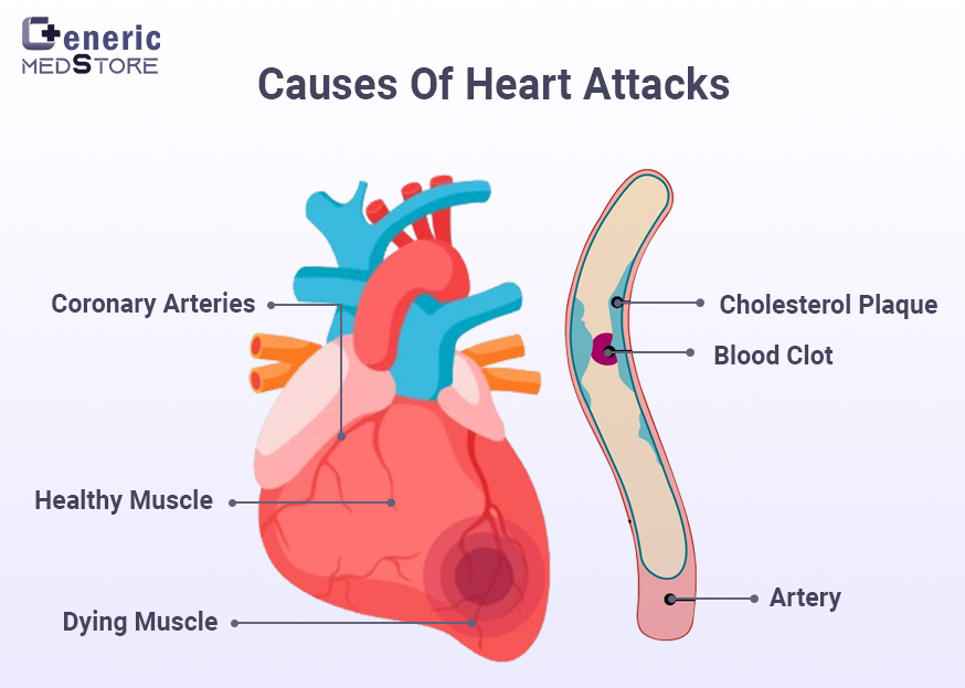 causes of heart attacks